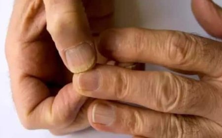 തൊലിപ്പുറത്ത് വരുന്ന തടിപ്പ് മുതല് നിറം മങ്ങിയ നഖങ്ങള് വരെ; അറിയാം കൊളസ്ട്രോളിന്റെ ലക്ഷണങ്ങള്